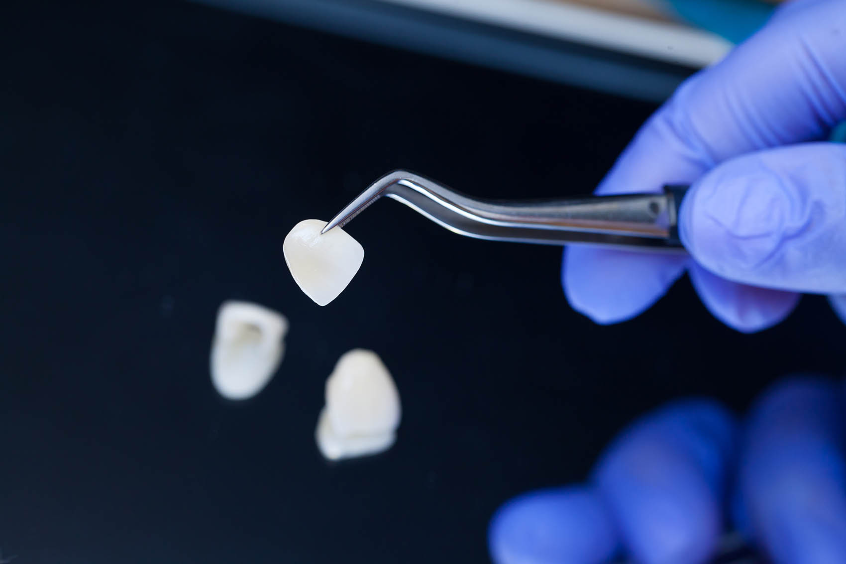 Getting your old porcelain veneers replaced