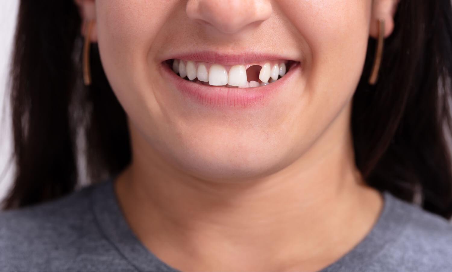 dental implants treatment Melbourne