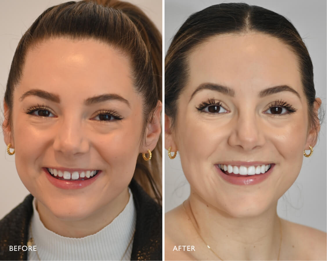 Smile makeovers
