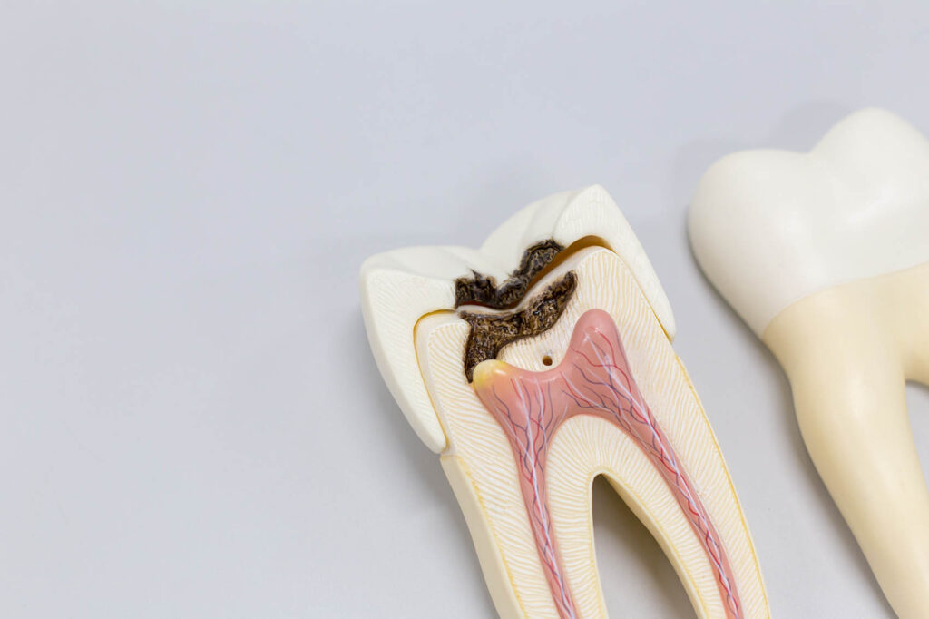 Root canal treatment in Melbourne