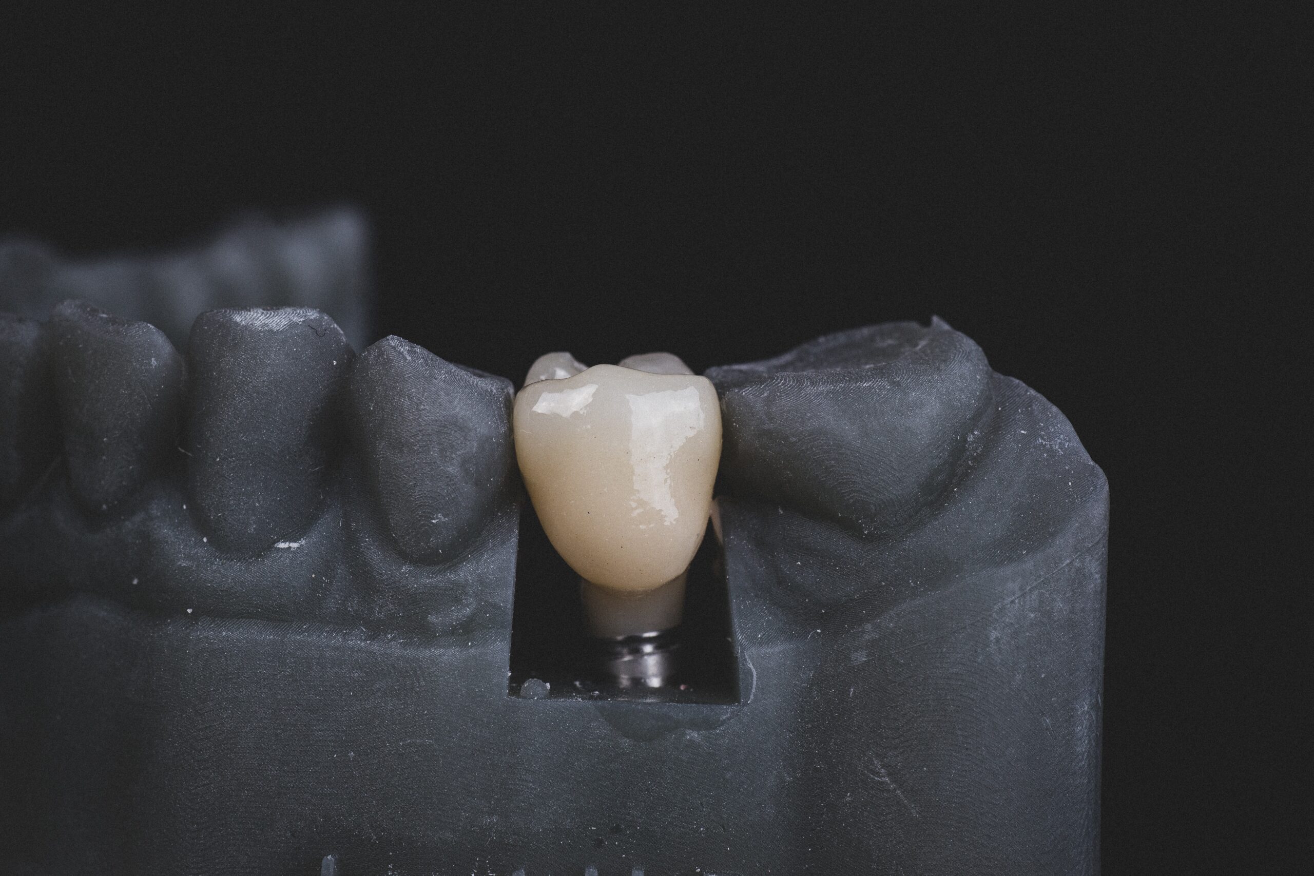 Why do veneers turn black?