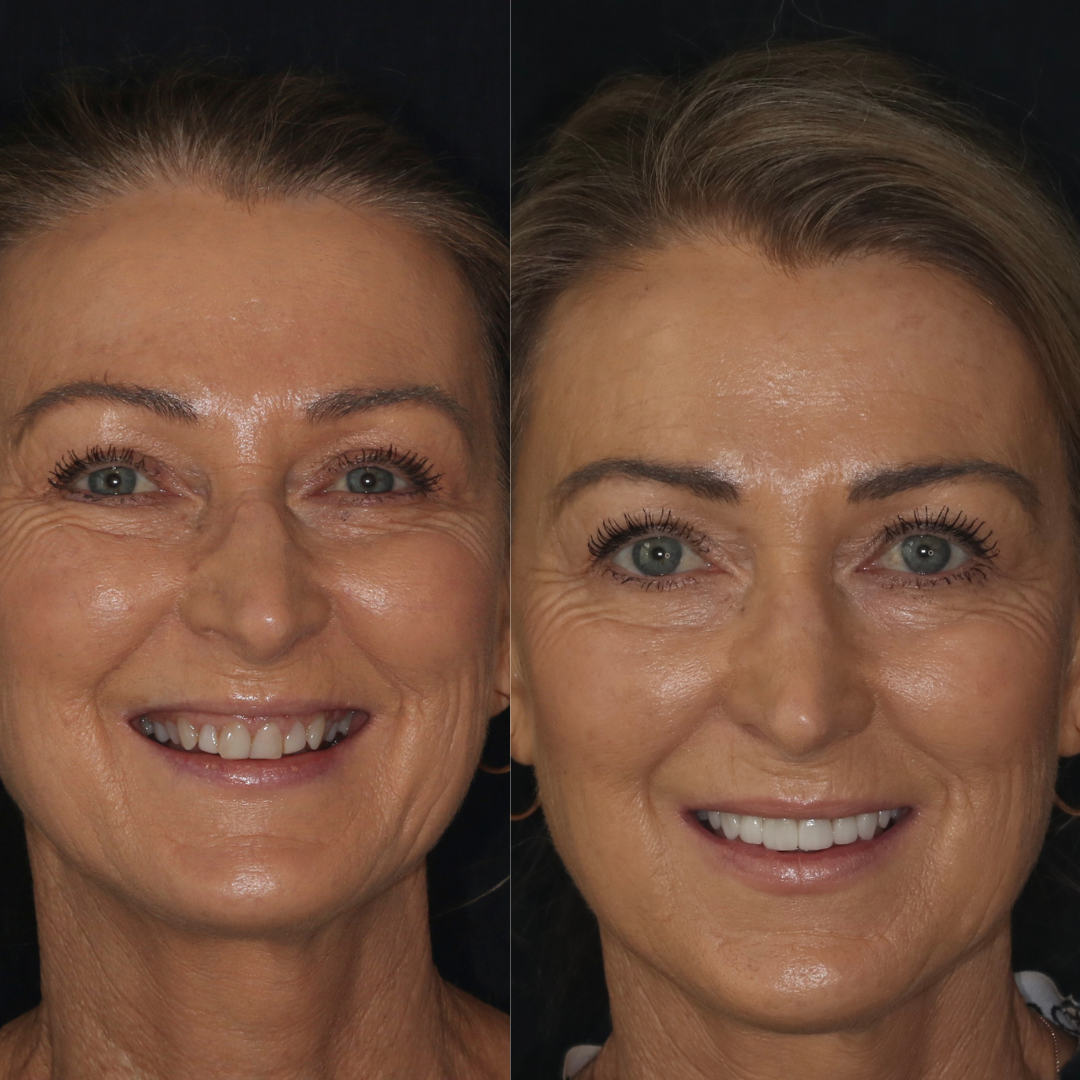 Before and After Veneers_ Witness the Magic