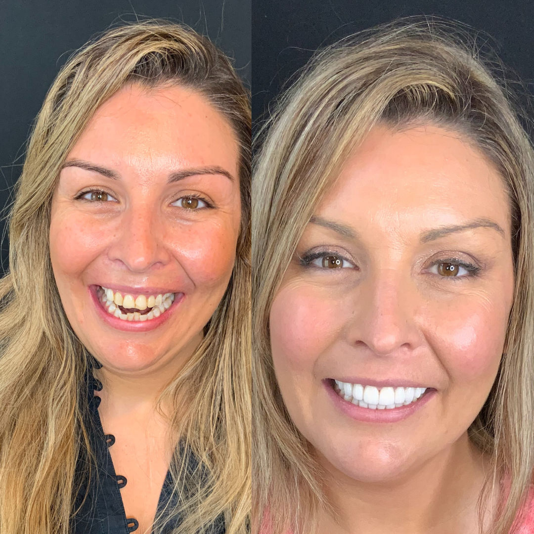 Dramatic Smile Transformation - Veneers Before and After