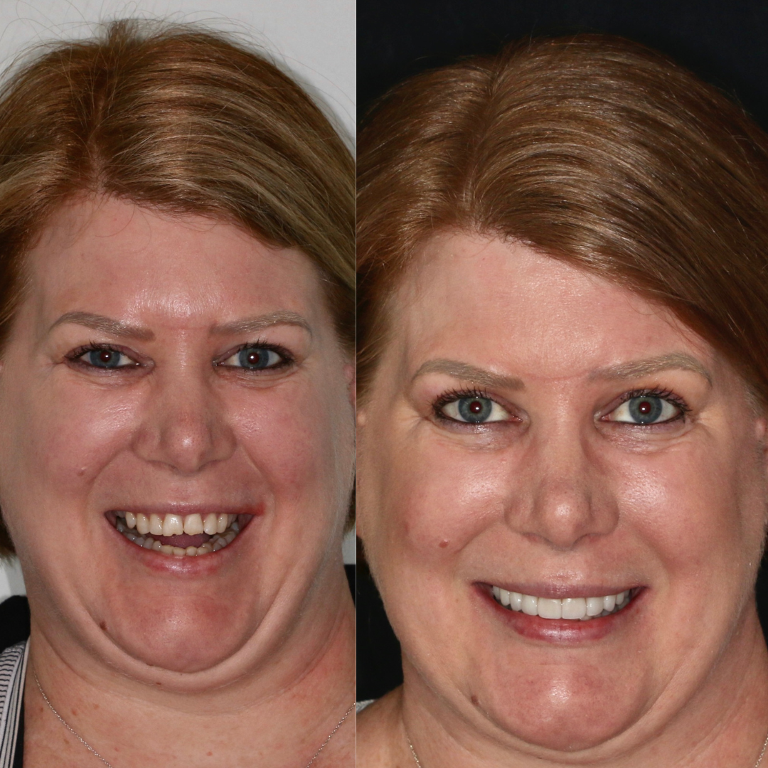 Veneers Results - A Remarkable Before and After Comparison