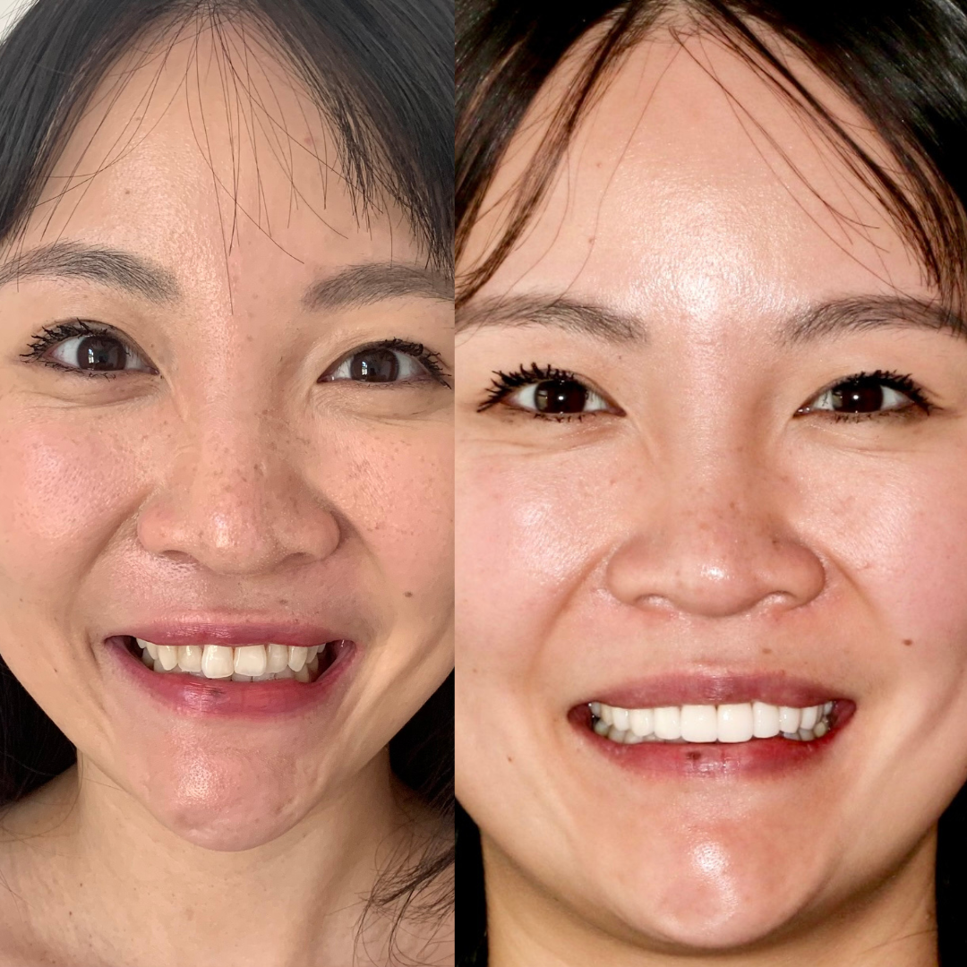 Veneers Results_ A Stunning Before and After Comparison
