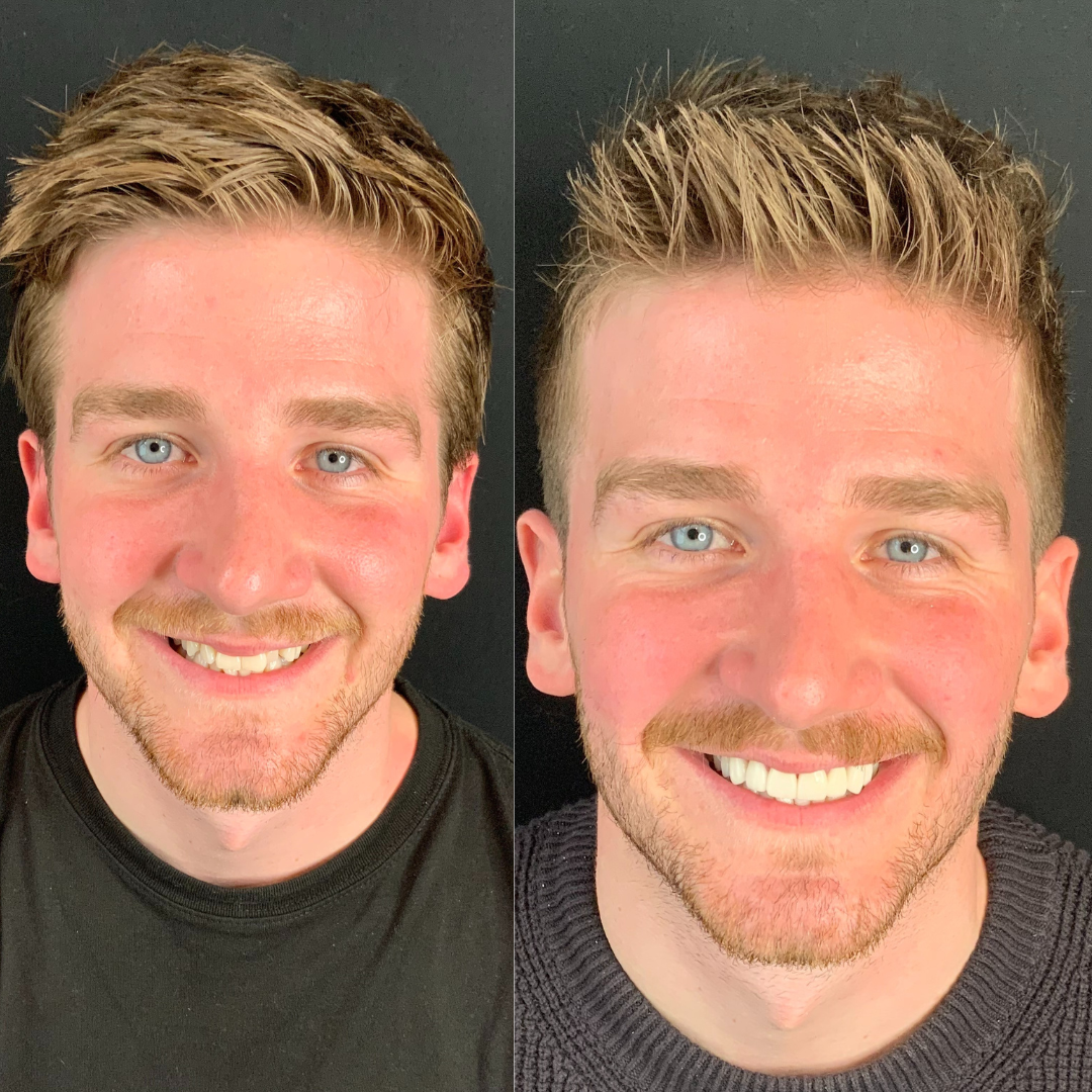 Veneers Transformation_ Captivating Before and After