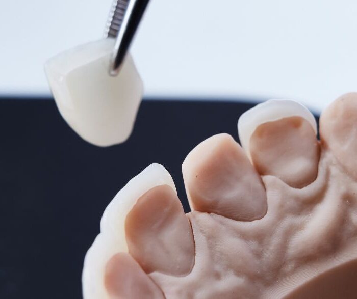 Dental Veneers on teeth moulds