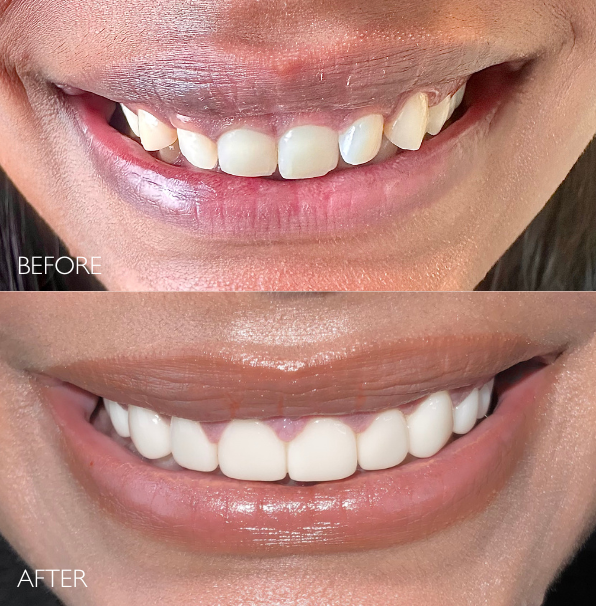 Before and after porcelain veneers treatment