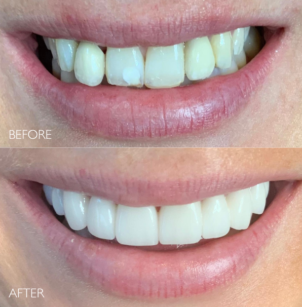 Patient with before and after porcelain veneers treatment in Melbourne