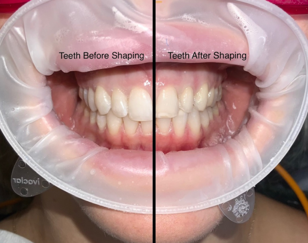 Teeth Before Shaping vs Teeth After Shaping
