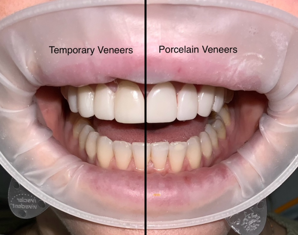 Temporary Veneers vs Porcelain Veneers