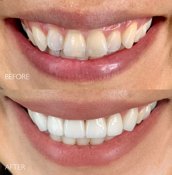 patient before and after porcelain veneers