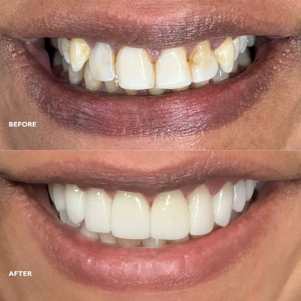 porcelain veneers before and after - Dental + Skin Clinic