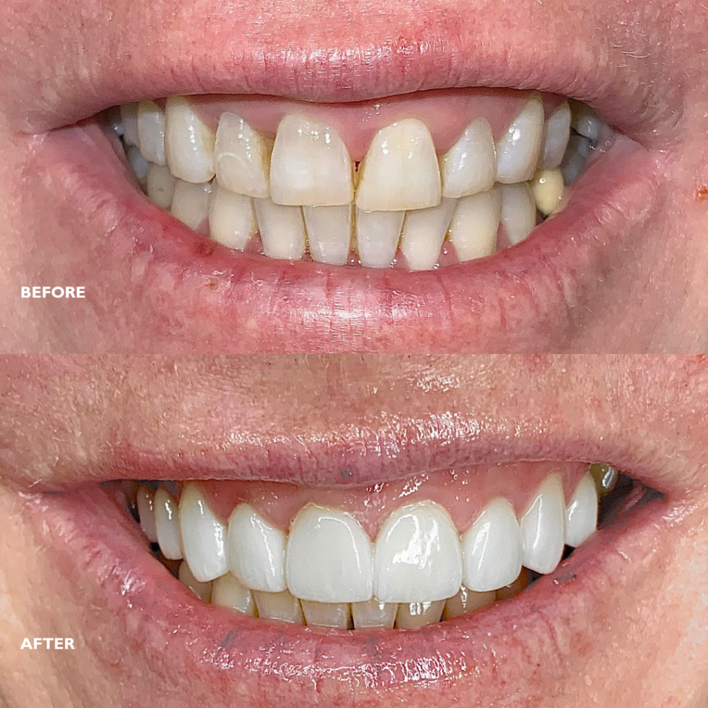 top teeth veneers before and after