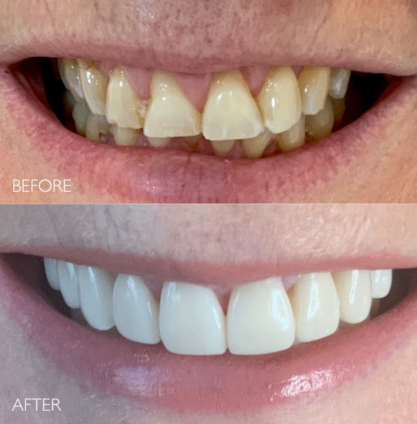 Composite veneers Hampton