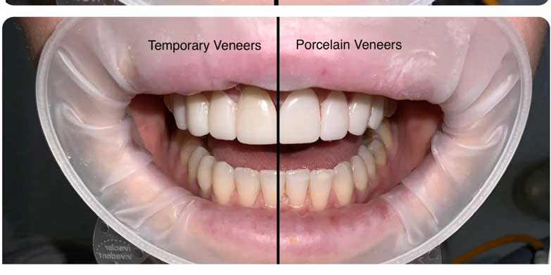 Bentleigh Professional Veneers