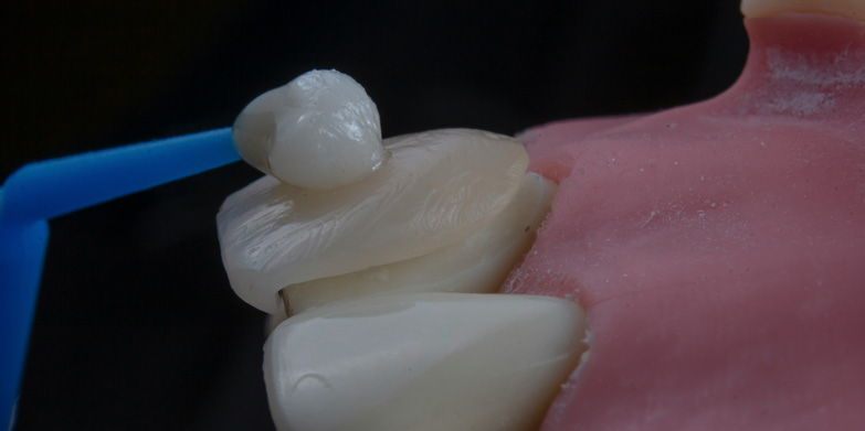 Dental Implants with Receding Gums?