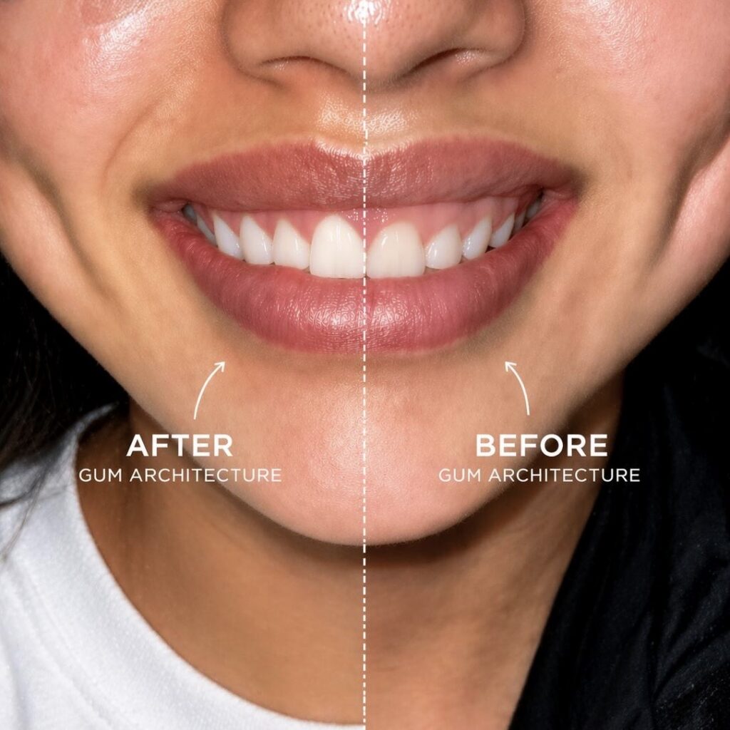 Side-by-side smile showing after-treatment gum architecture on the left and before on the right, with a center guideline dividing them.