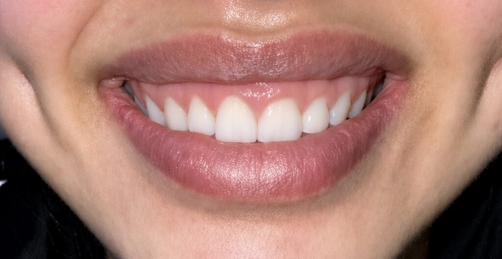 Close-up of a person smiling, showing clean white teeth and pink lips.