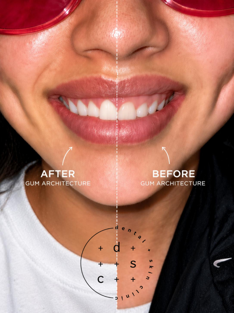Split-image showing after (left) and before (right) gum architecture around a smiling mouth.